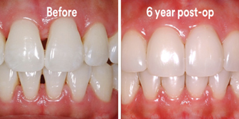 BioClear Diastema Closure and Black Triangle Closure  - Two Rivers Dental, Bolingbrook Dentist