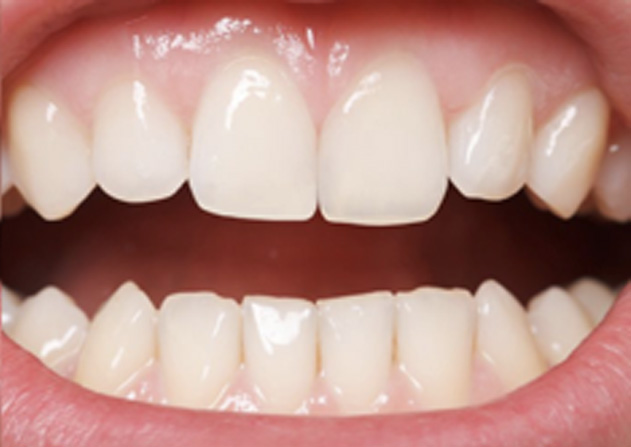 Cosmetic Bonding  - Two Rivers Dental, Bolingbrook Dentist