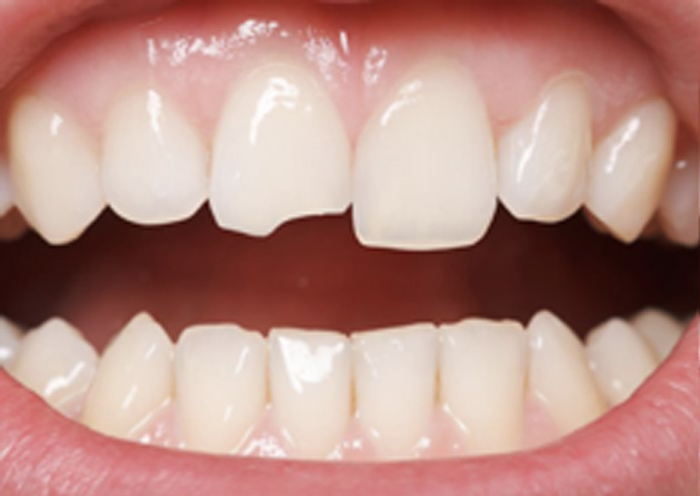 Cosmetic Bonding  - Two Rivers Dental, Bolingbrook Dentist