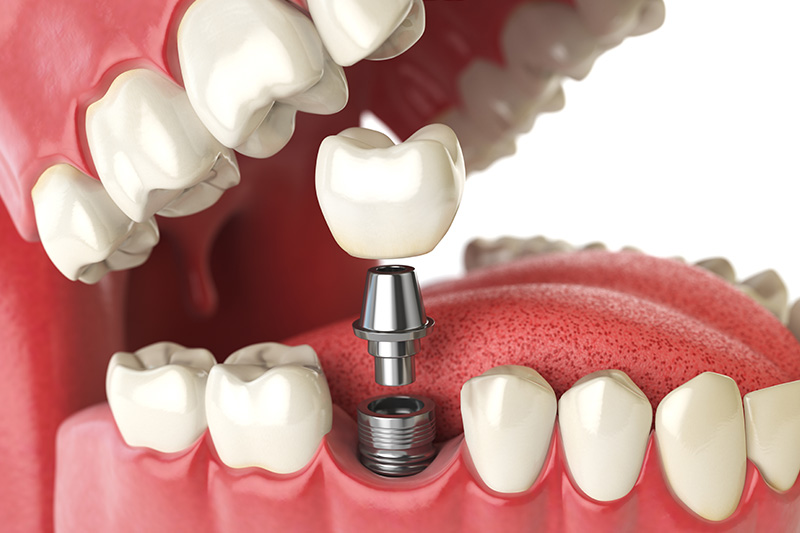 Dental Implants - Two Rivers Dental, Bolingbrook Dentist
