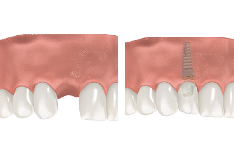 Dental Implants - Two Rivers Dental, Bolingbrook Dentist