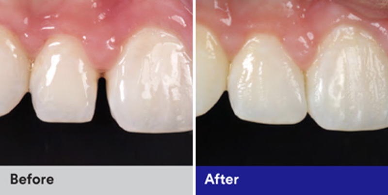 BioClear Diastema Closure and Black Triangle Closure  - Two Rivers Dental, Bolingbrook Dentist