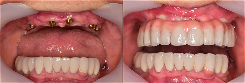 Implant Overdentures and Fixed All-On-X Treatment  - Two Rivers Dental, Bolingbrook Dentist