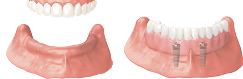 Implant Overdentures and Fixed All-On-X Treatment  - Two Rivers Dental, Bolingbrook Dentist