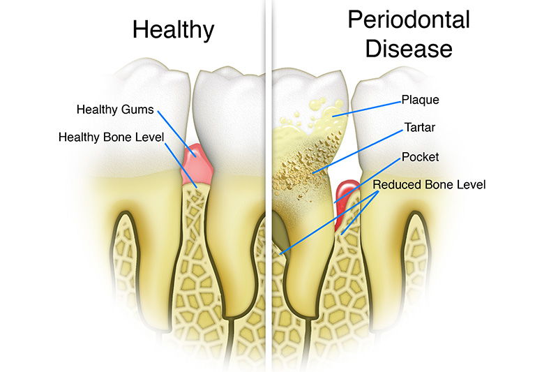 Scaling & Root Planings (Deep Cleanings)  - Two Rivers Dental, Bolingbrook Dentist