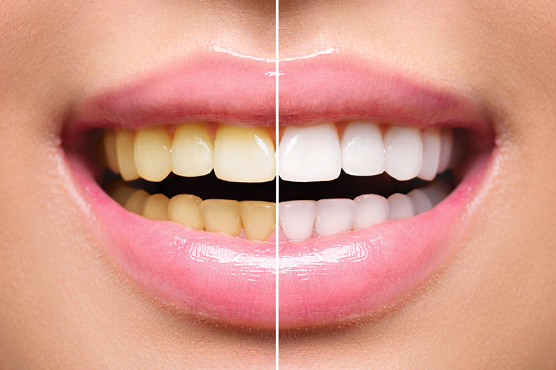 Teeth Whitening - Two Rivers Dental, Bolingbrook Dentist