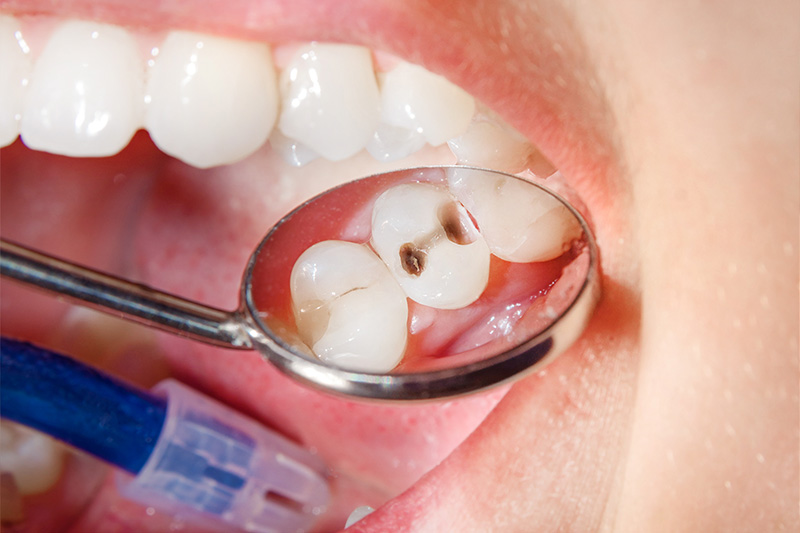 Tooth Colored Composite Fillings  - Two Rivers Dental, Bolingbrook Dentist