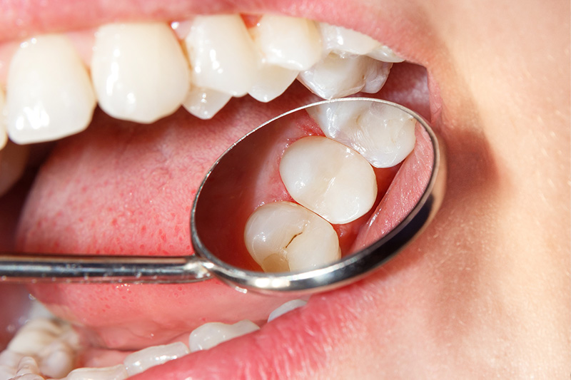 Tooth Colored Composite Fillings  - Two Rivers Dental, Bolingbrook Dentist