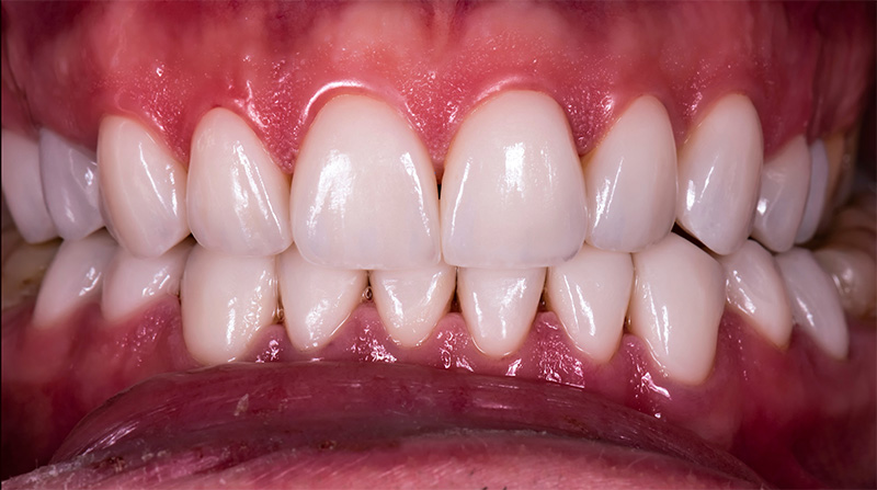Veneers  - Two Rivers Dental, Bolingbrook Dentist