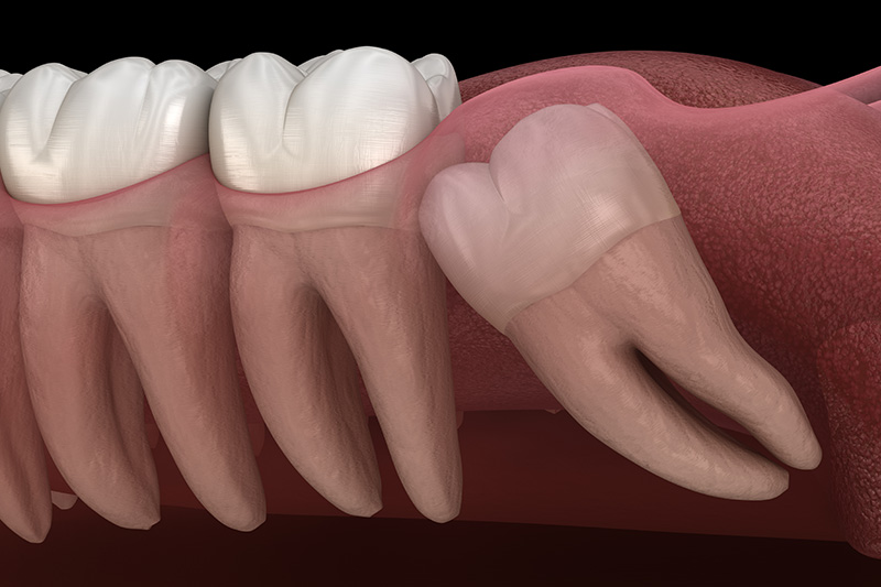 Extracciones de Muelas del Juicio (con Sedante)  - Two Rivers Dental, Bolingbrook Dentist